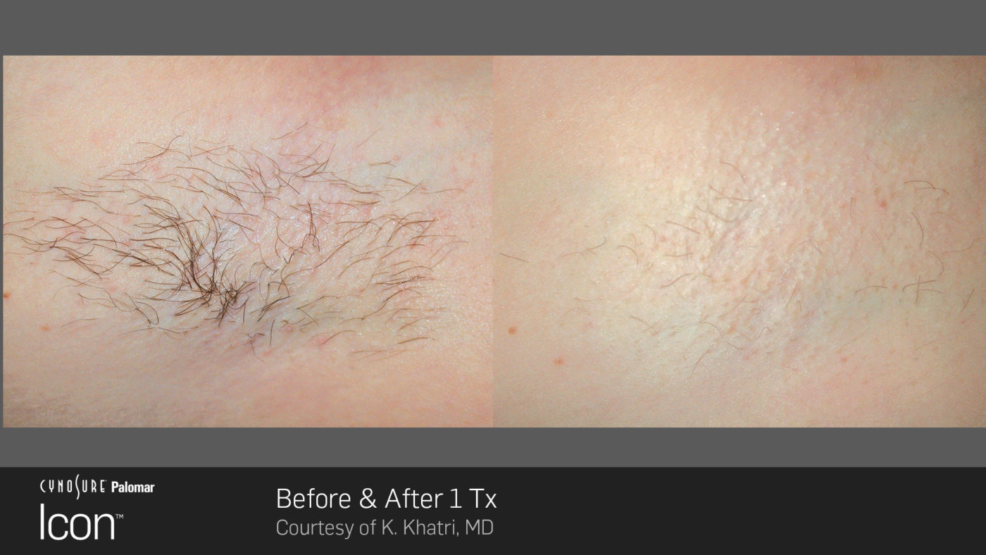 Hair-Removal-Before-After-4