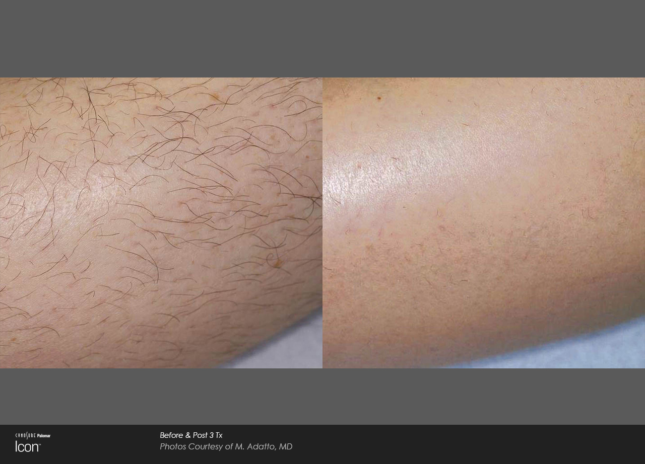 Hair-Removal-Before-After-Photo-2