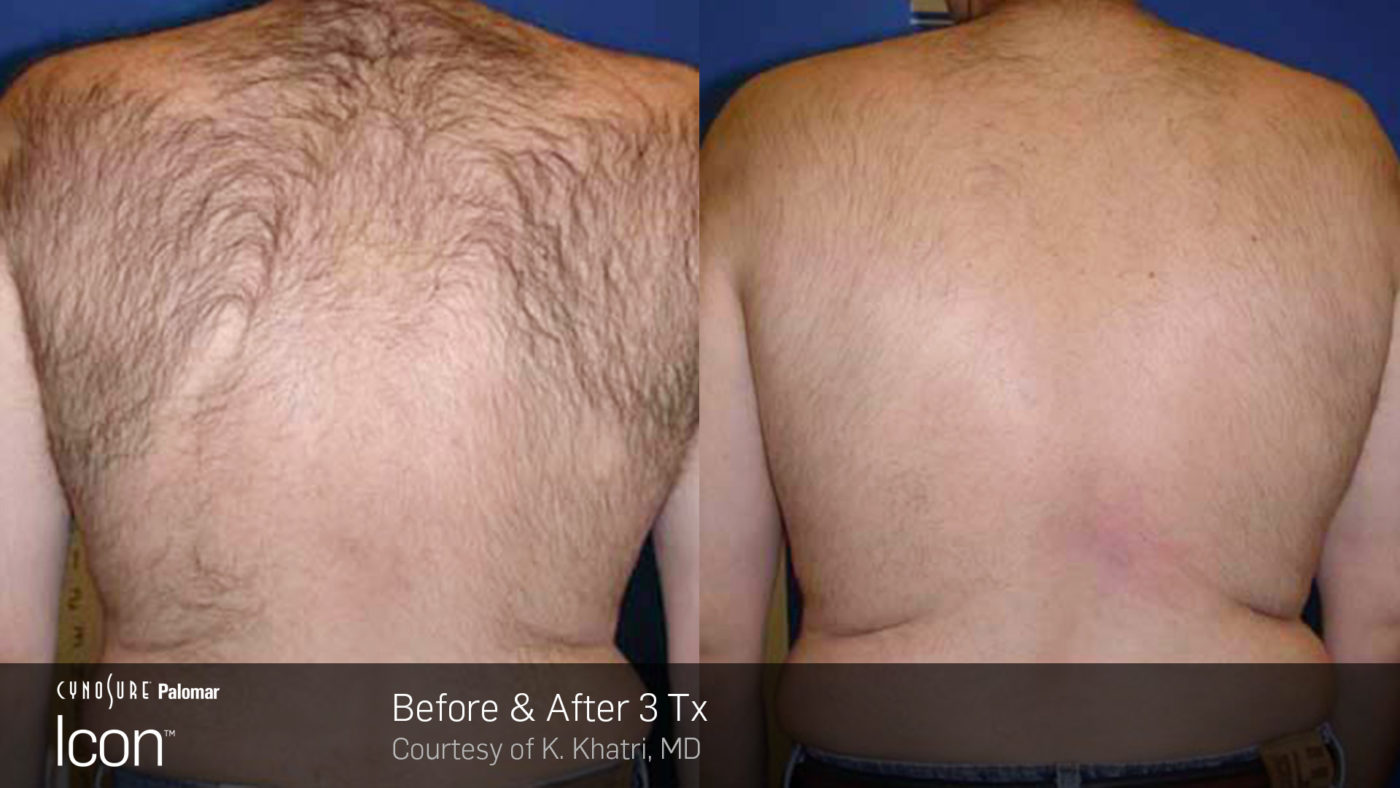 Hair-Removal-Before-After-Photo-5 (1)