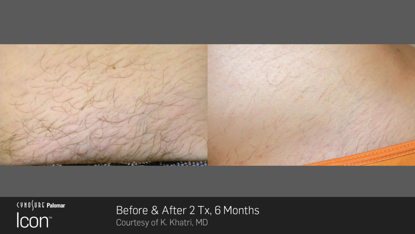 Hair-Removal-Before-After-Photo-7
