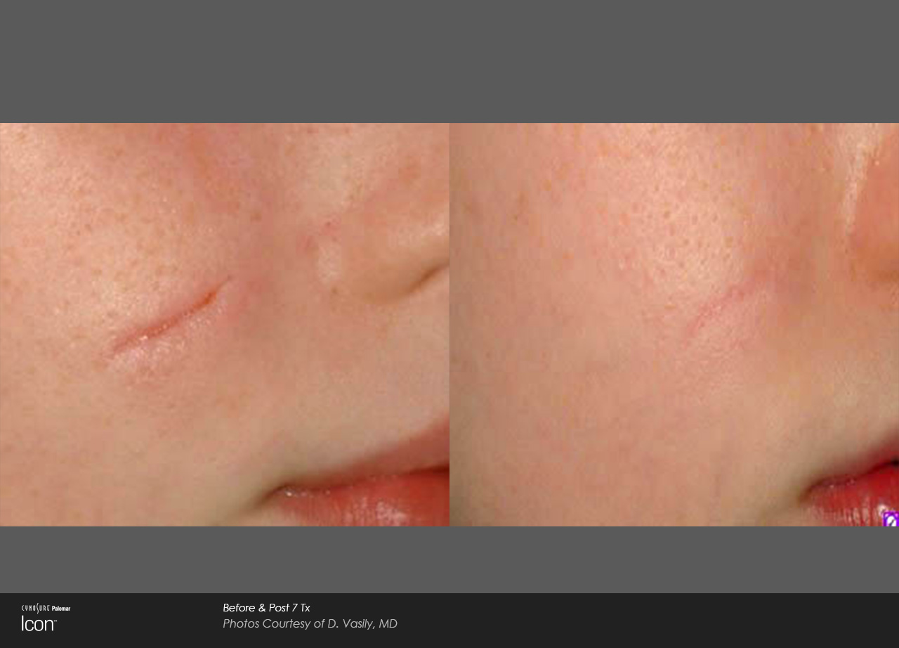 Scar-Removal-Before-and-After-Images-2
