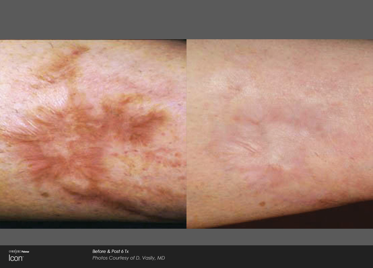 Scar-Removal-Before-and-After-Images-4 (1)