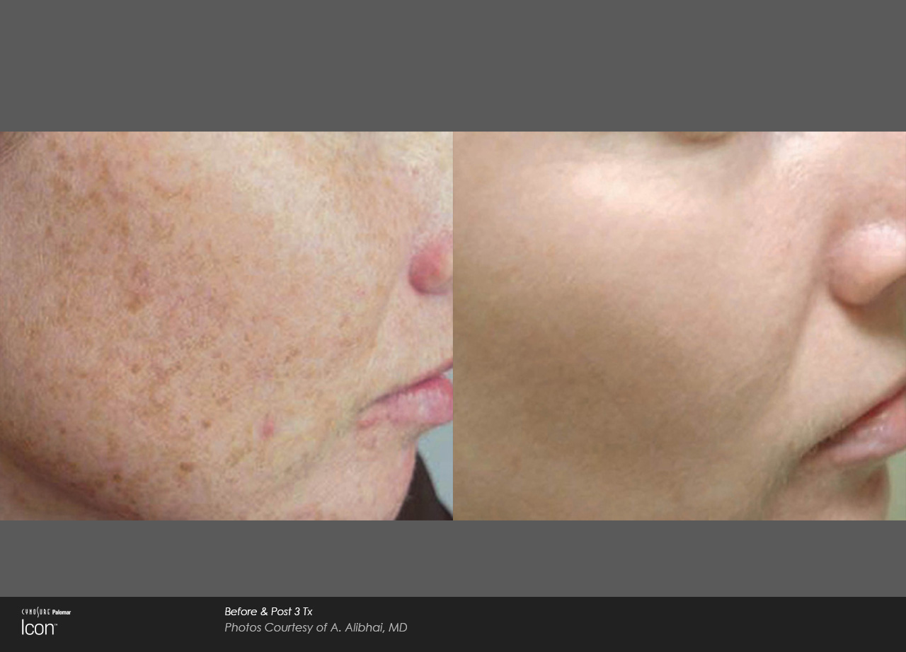 Skin-Revitalization-Before-After-Photo-1