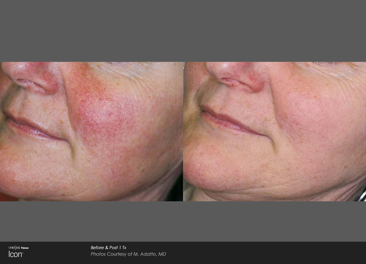 Skin-Revitalization-Before-After-Photo-5