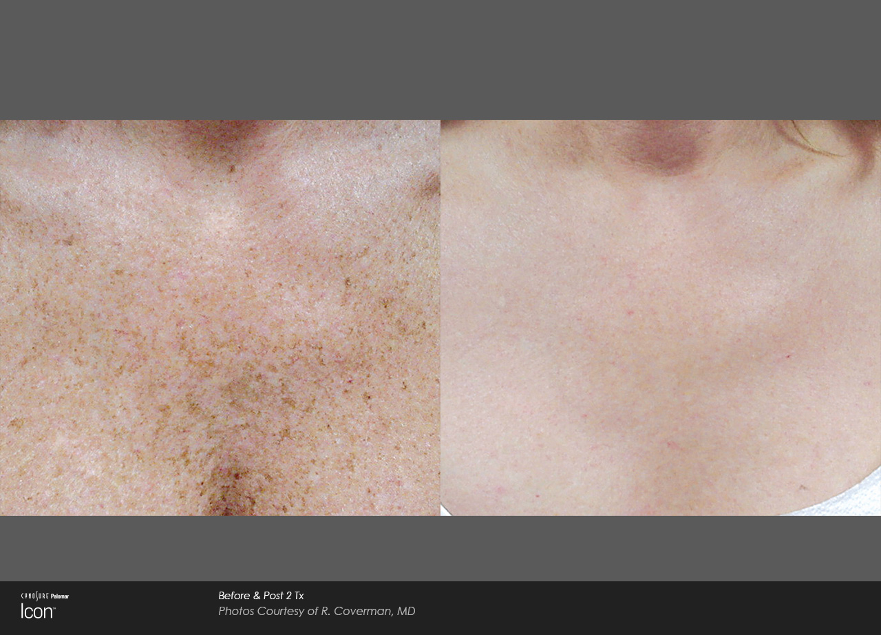 Skin-Revitalization-Before-After-Photo-7