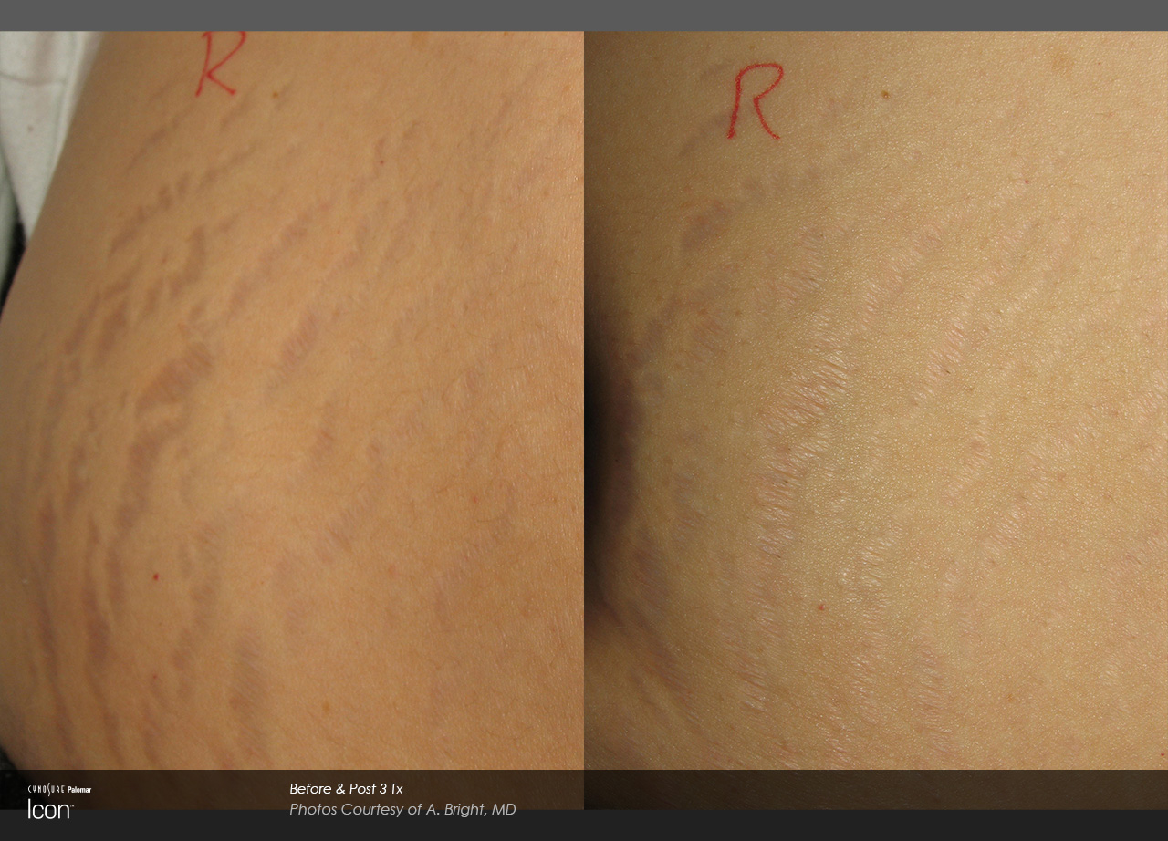 Stretch-Mark-Before-After-2_0