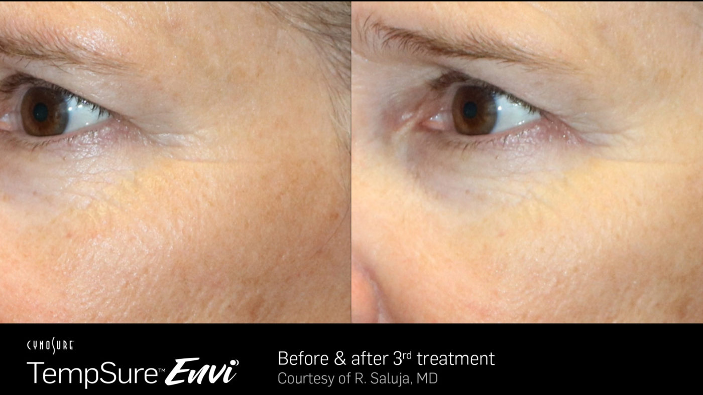 TempSure-Envi-Before-and-After-Image15