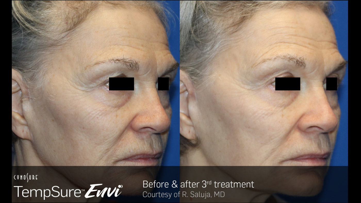 TempSure-Envi-Before-and-After-Image4
