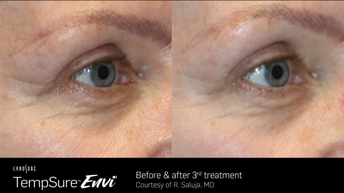 TempSure-Envi-Before-and-After-Image_2