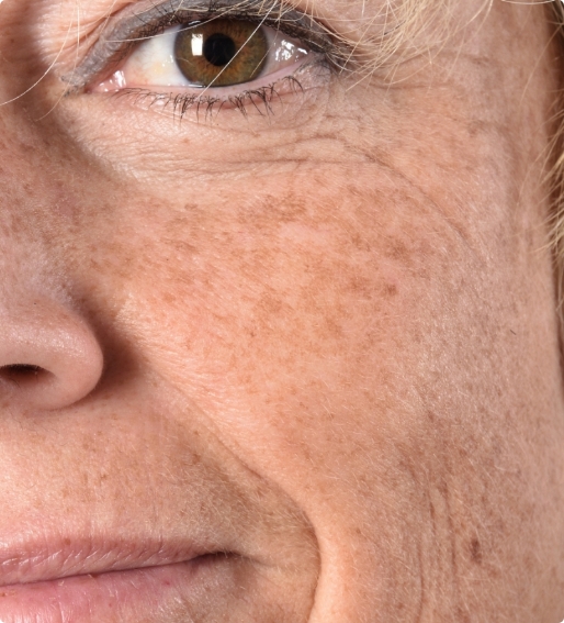 woman with hyper pigmentation